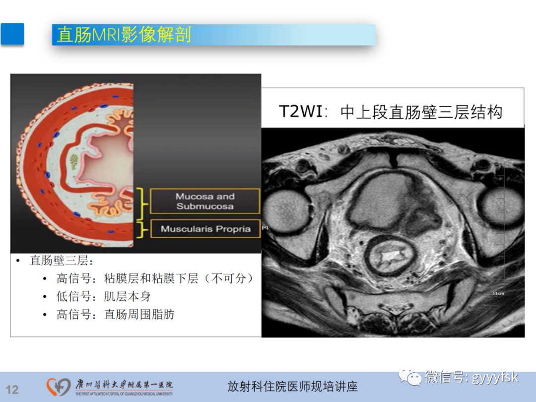 影像PPT - 【PPT】直肠癌MRI规范扫描及分期诊断-13
