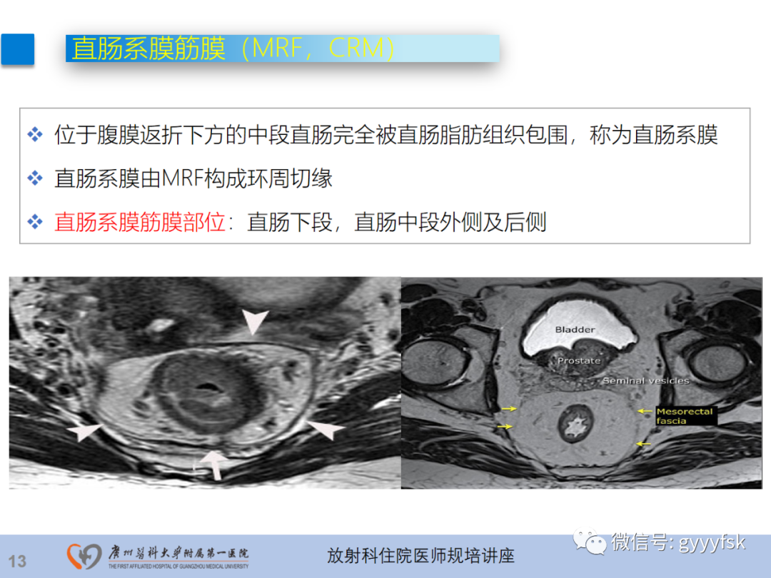 影像PPT - 【PPT】直肠癌MRI规范扫描及分期诊断-14