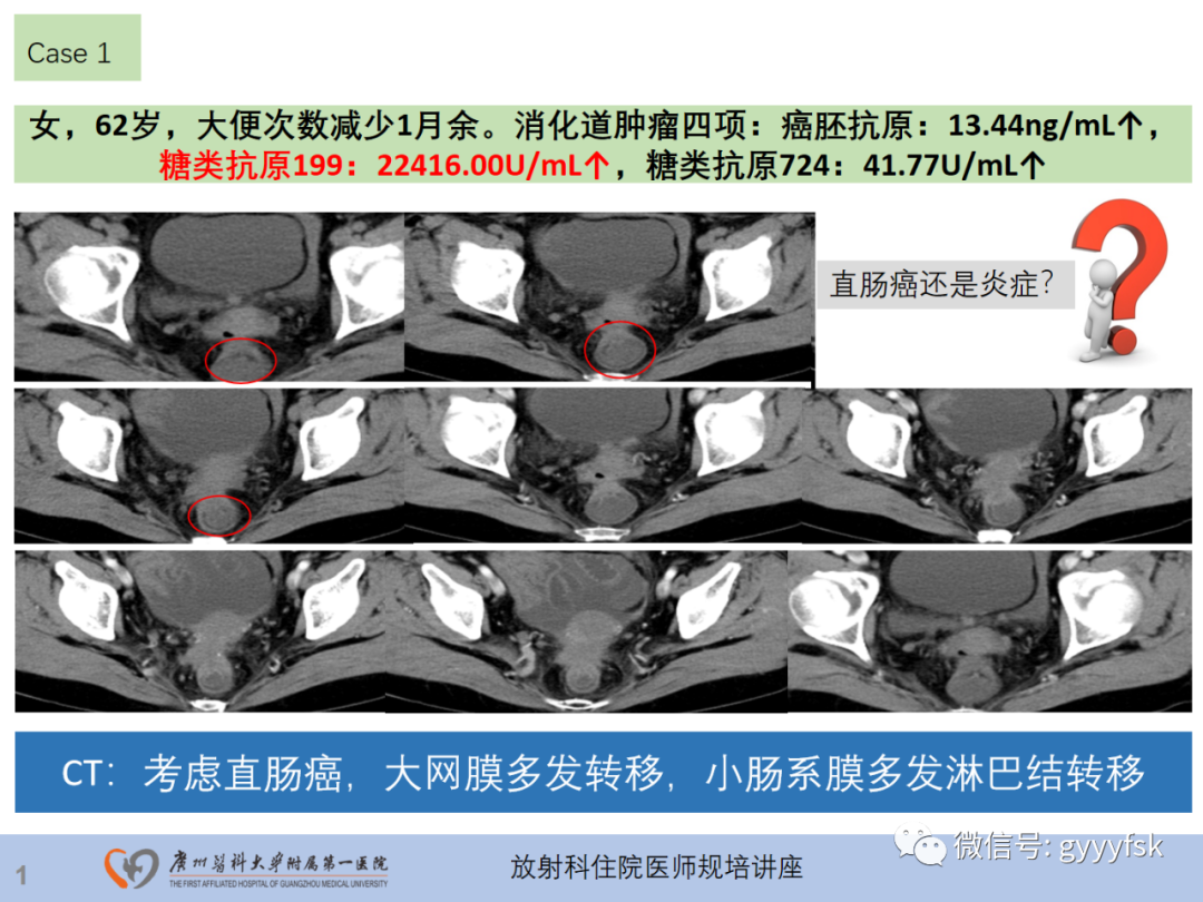 影像PPT - 【PPT】直肠癌MRI规范扫描及分期诊断-2