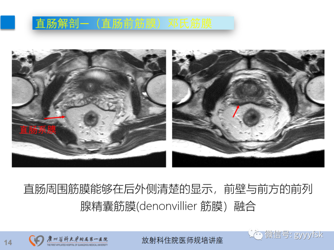 影像PPT - 【PPT】直肠癌MRI规范扫描及分期诊断-15