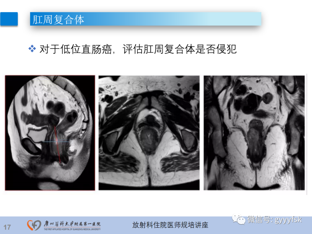 影像PPT - 【PPT】直肠癌MRI规范扫描及分期诊断-18