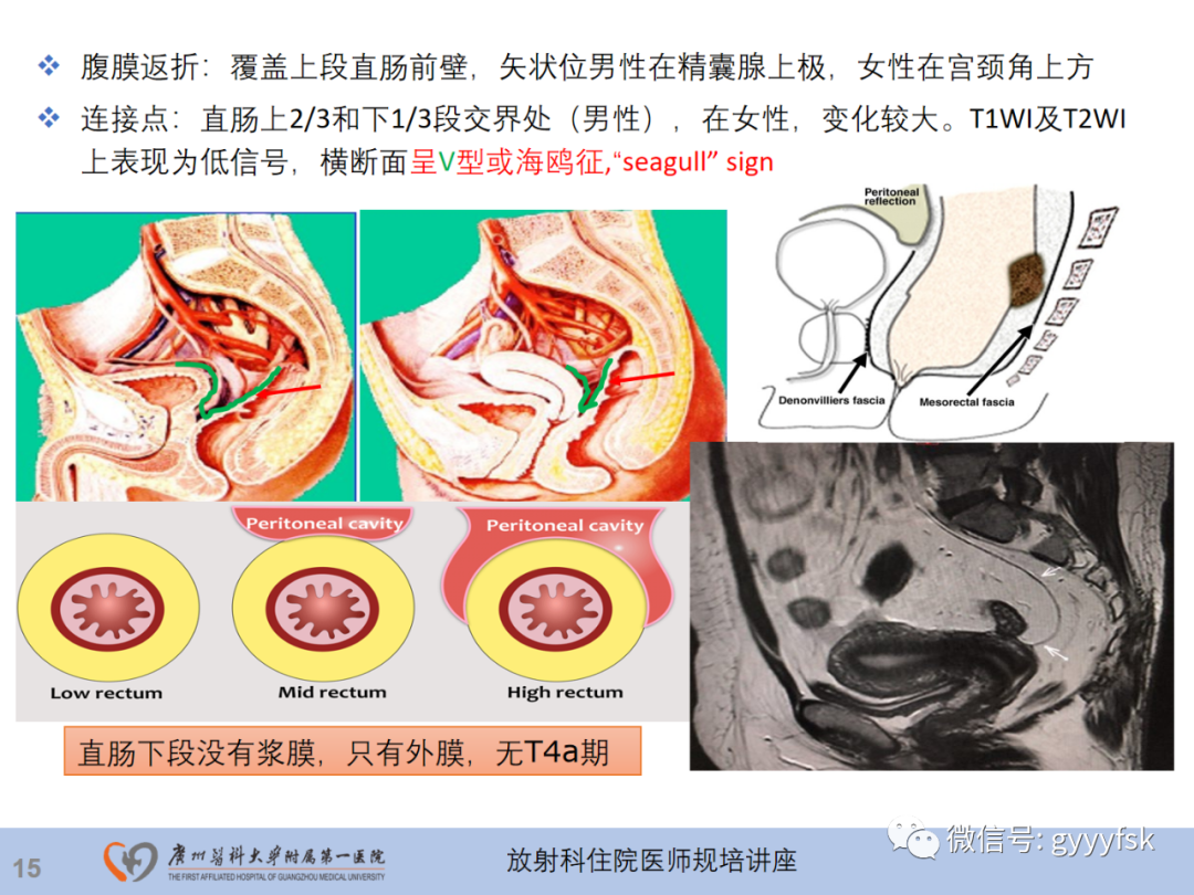 影像PPT - 【PPT】直肠癌MRI规范扫描及分期诊断-16
