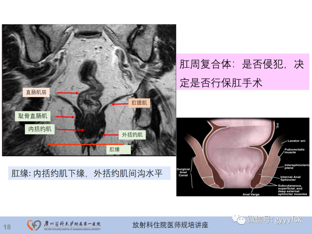 影像PPT - 【PPT】直肠癌MRI规范扫描及分期诊断-19