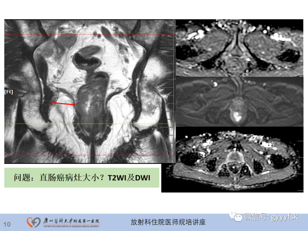 影像PPT - 【PPT】直肠癌MRI规范扫描及分期诊断-11