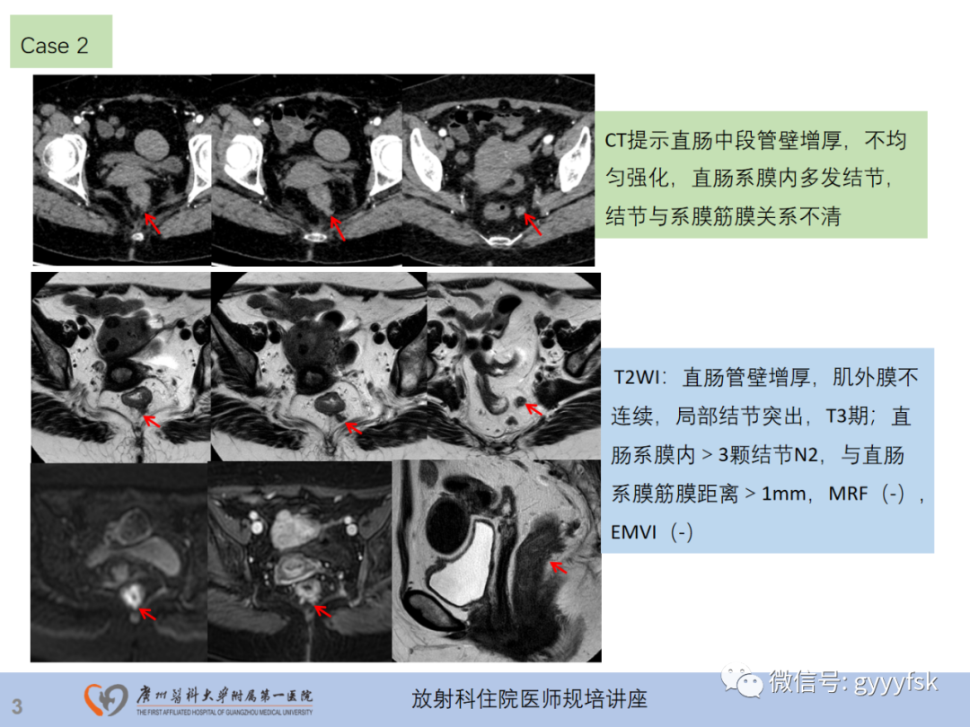 影像PPT - 【PPT】直肠癌MRI规范扫描及分期诊断-4