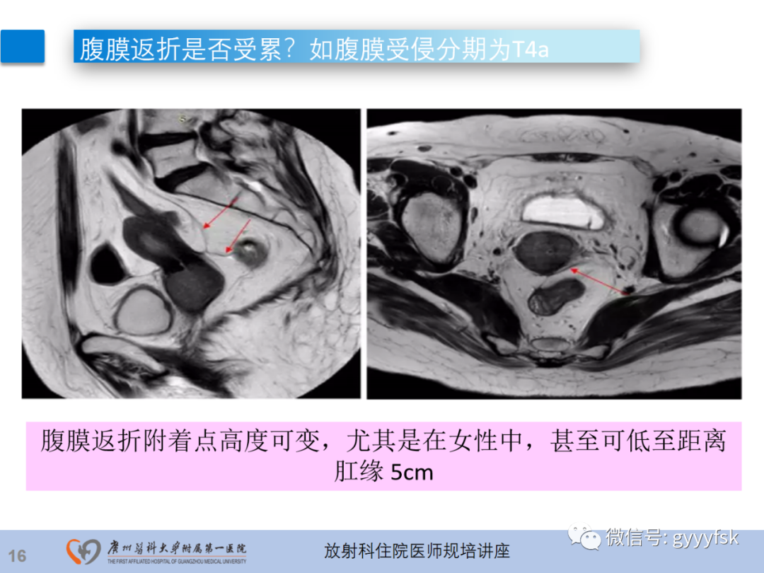 影像PPT - 【PPT】直肠癌MRI规范扫描及分期诊断-17