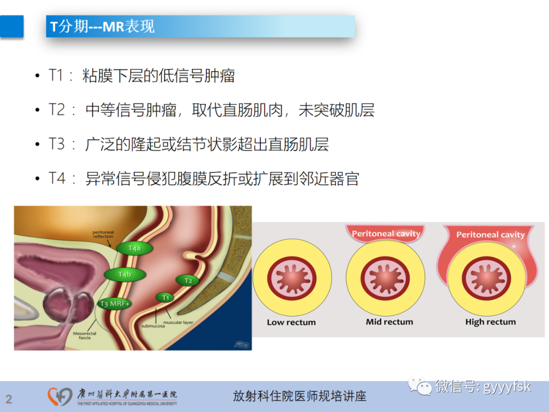 影像PPT - 【PPT】直肠癌MRI规范扫描及分期诊断-24