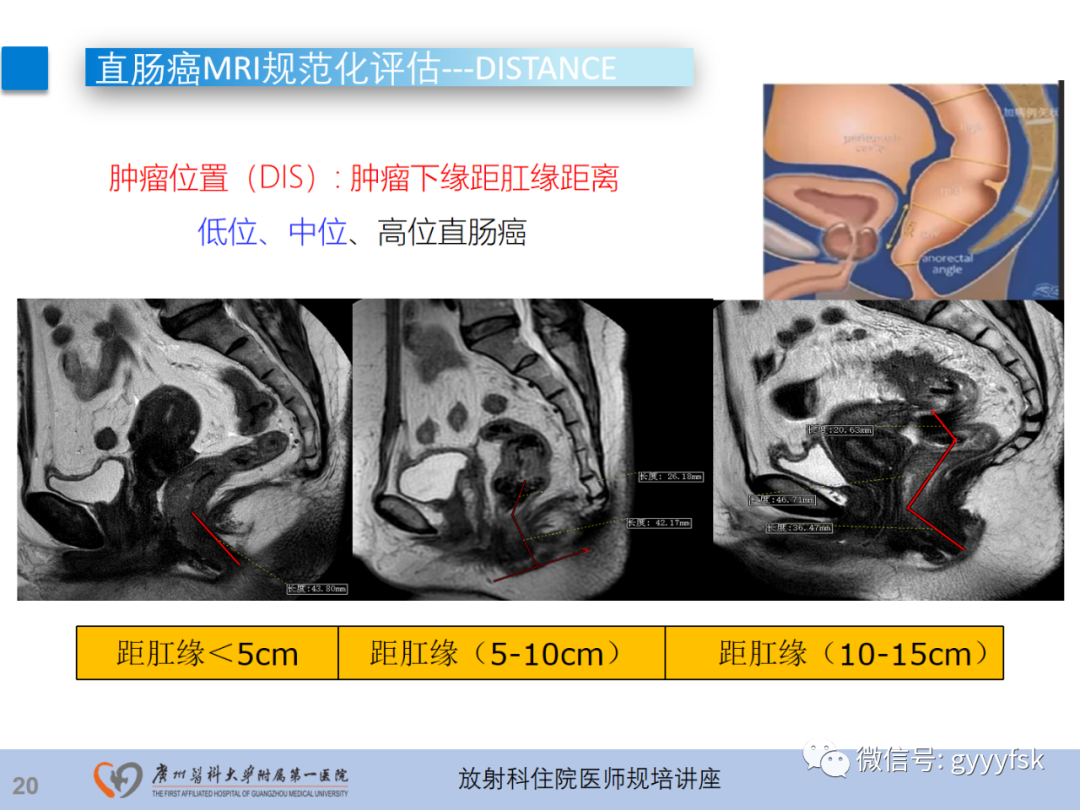 影像PPT - 【PPT】直肠癌MRI规范扫描及分期诊断-21