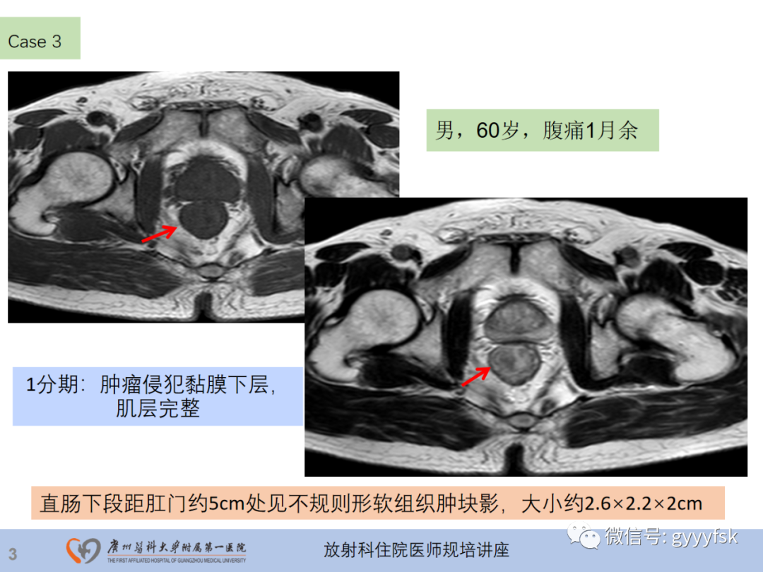 影像PPT - 【PPT】直肠癌MRI规范扫描及分期诊断-25