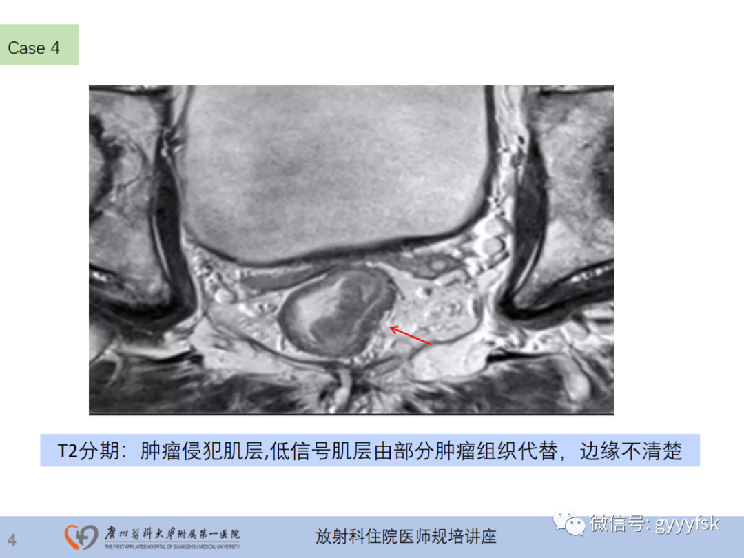 影像PPT - 【PPT】直肠癌MRI规范扫描及分期诊断-26
