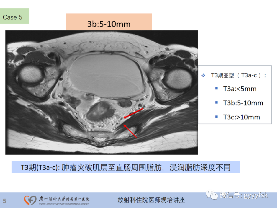 影像PPT - 【PPT】直肠癌MRI规范扫描及分期诊断-27
