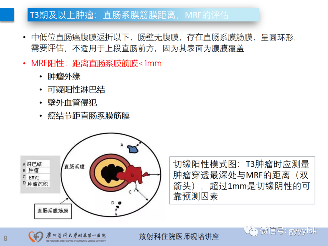 影像PPT - 【PPT】直肠癌MRI规范扫描及分期诊断-30