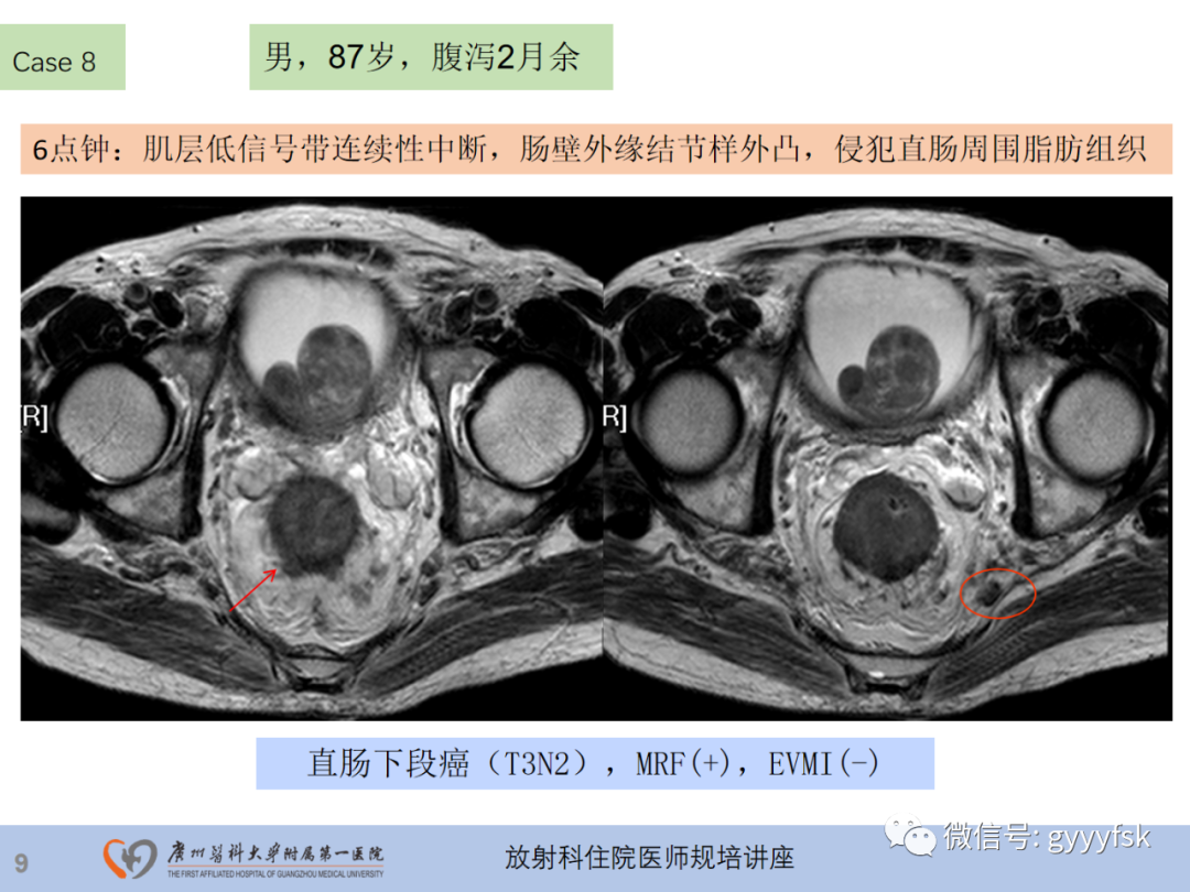 影像PPT - 【PPT】直肠癌MRI规范扫描及分期诊断-31