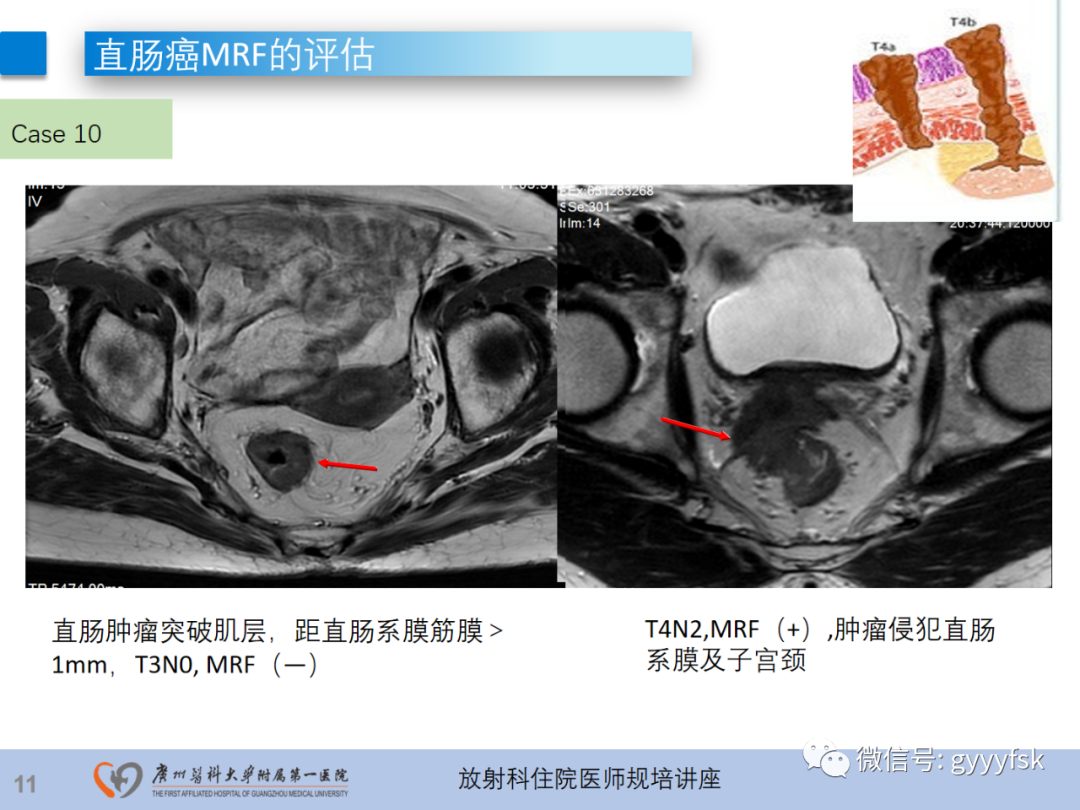 影像PPT - 【PPT】直肠癌MRI规范扫描及分期诊断-33