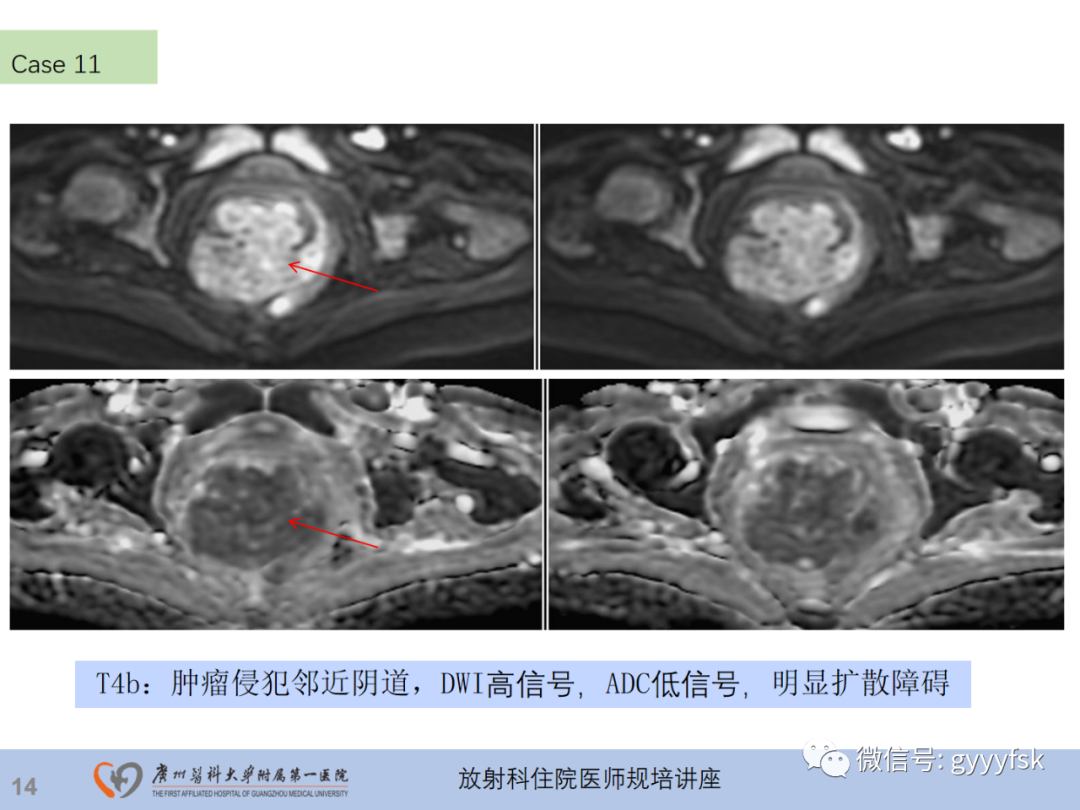 影像PPT - 【PPT】直肠癌MRI规范扫描及分期诊断-35