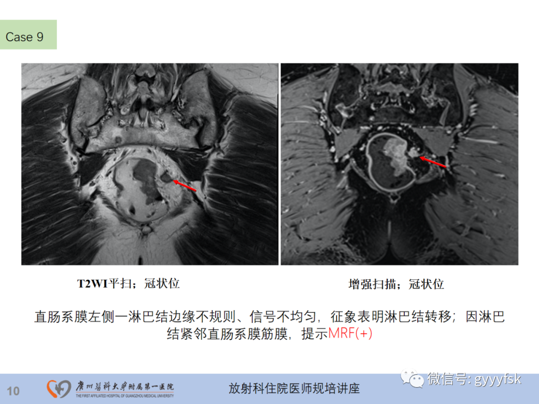 影像PPT - 【PPT】直肠癌MRI规范扫描及分期诊断-32