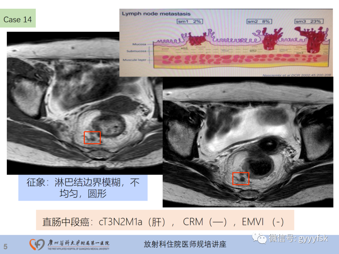 影像PPT - 【PPT】直肠癌MRI规范扫描及分期诊断-42