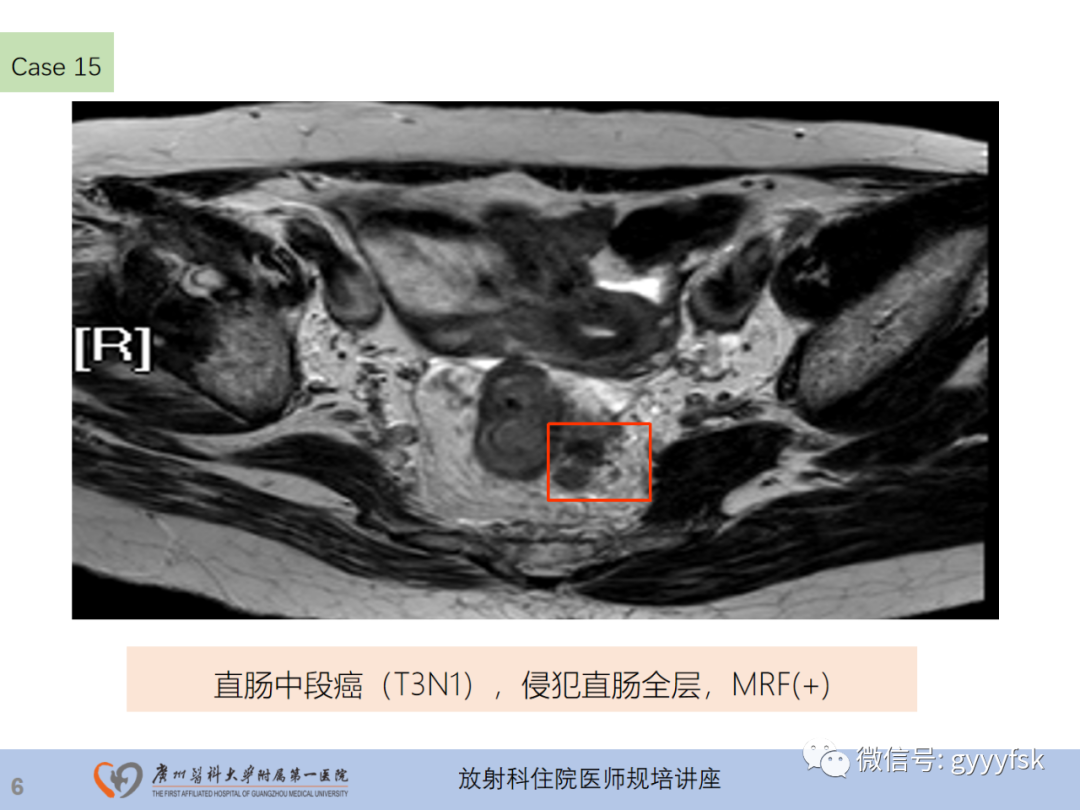 影像PPT - 【PPT】直肠癌MRI规范扫描及分期诊断-43