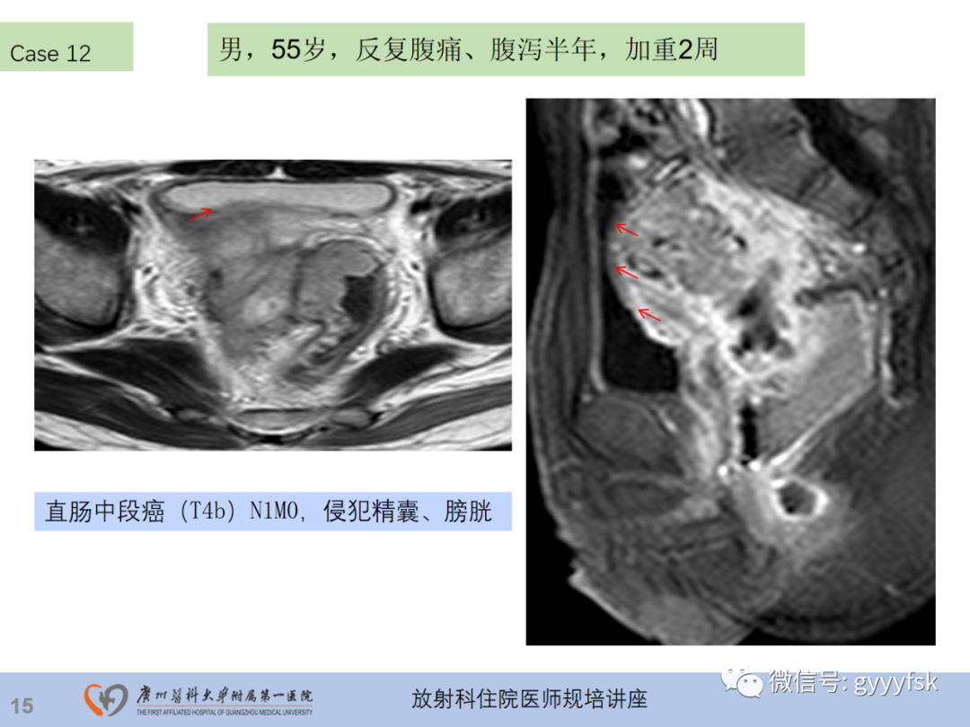 影像PPT - 【PPT】直肠癌MRI规范扫描及分期诊断-36