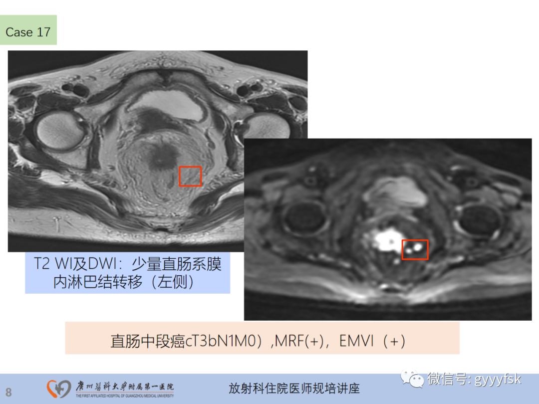 影像PPT - 【PPT】直肠癌MRI规范扫描及分期诊断-45