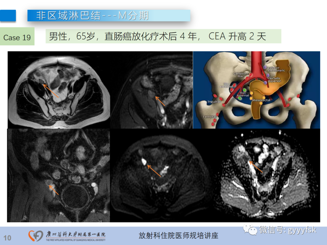 影像PPT - 【PPT】直肠癌MRI规范扫描及分期诊断-47