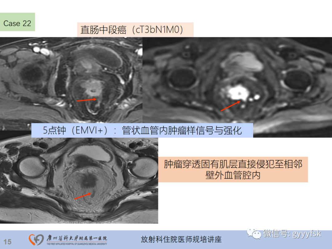 影像PPT - 【PPT】直肠癌MRI规范扫描及分期诊断-52