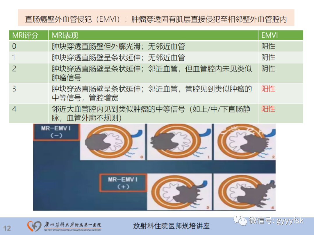影像PPT - 【PPT】直肠癌MRI规范扫描及分期诊断-49