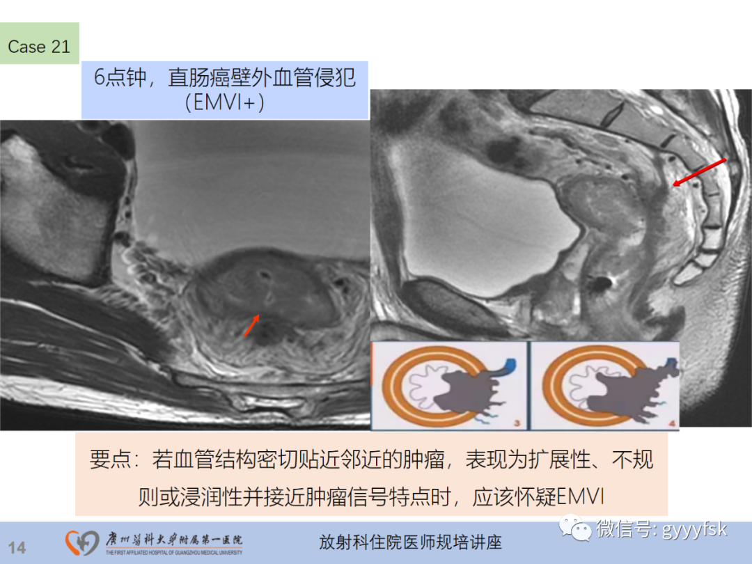 影像PPT - 【PPT】直肠癌MRI规范扫描及分期诊断-51