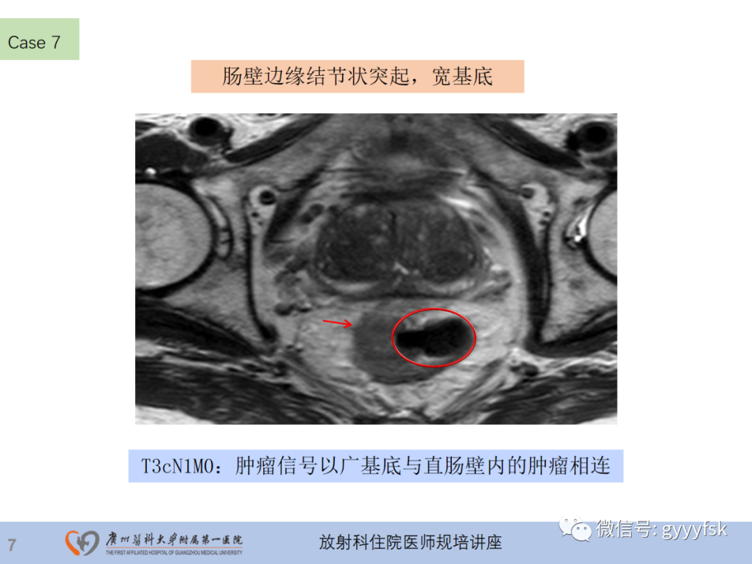 影像PPT - 【PPT】直肠癌MRI规范扫描及分期诊断-29