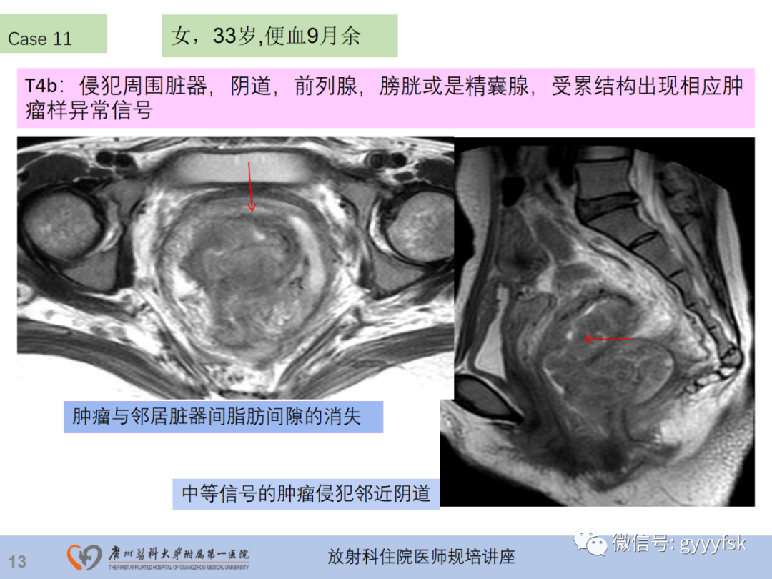 影像PPT - 【PPT】直肠癌MRI规范扫描及分期诊断-34