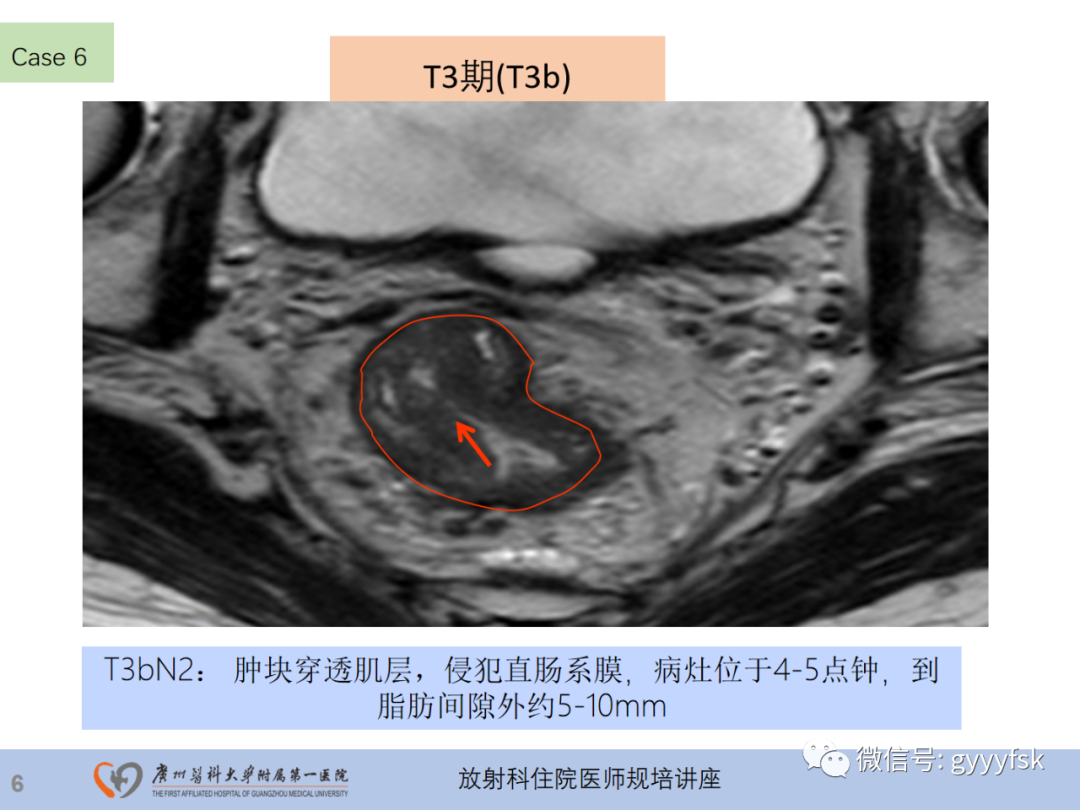 影像PPT - 【PPT】直肠癌MRI规范扫描及分期诊断-28