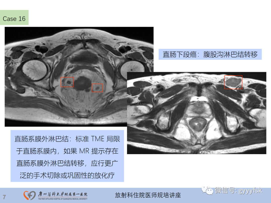 影像PPT - 【PPT】直肠癌MRI规范扫描及分期诊断-44