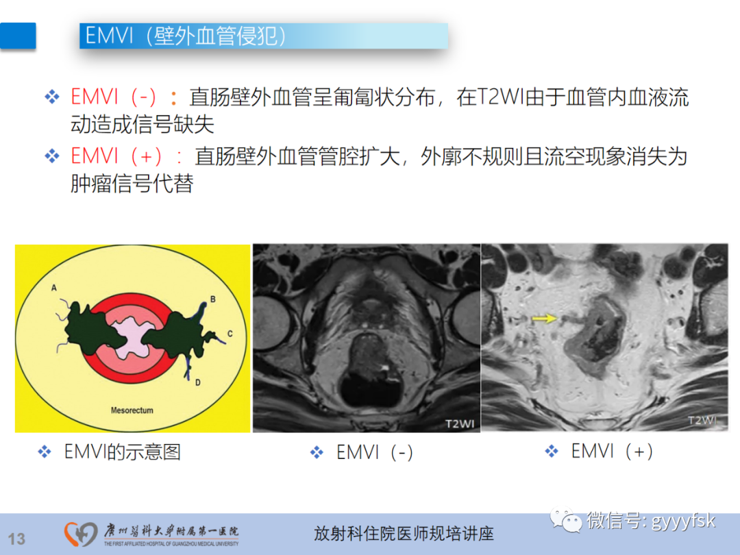 影像PPT - 【PPT】直肠癌MRI规范扫描及分期诊断-50