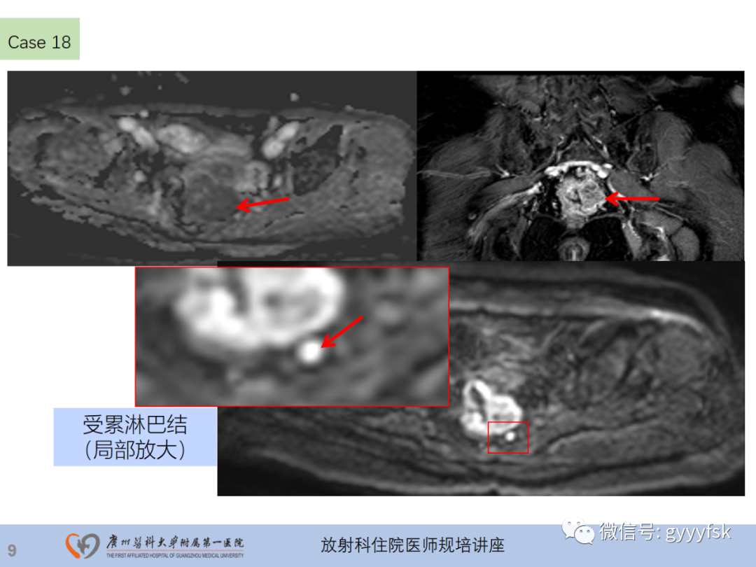 影像PPT - 【PPT】直肠癌MRI规范扫描及分期诊断-46