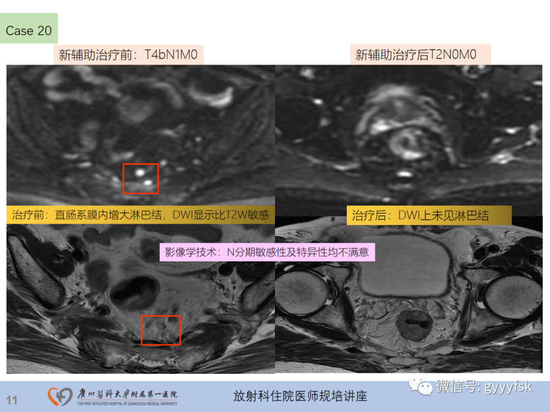 影像PPT - 【PPT】直肠癌MRI规范扫描及分期诊断-48