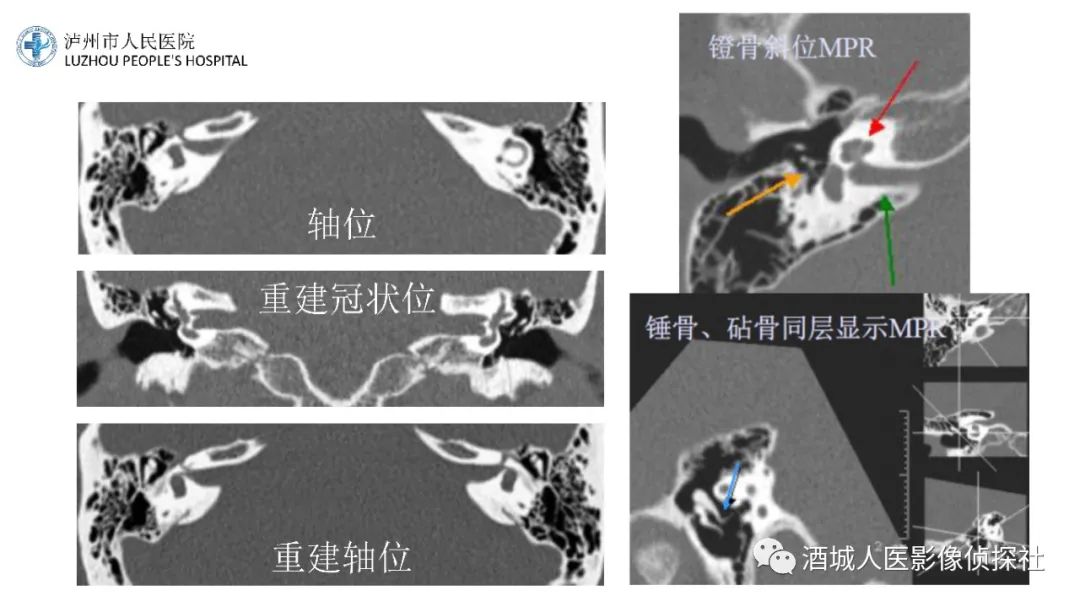 影像PPT - 【PPT】传导性耳聋的CT诊断-8