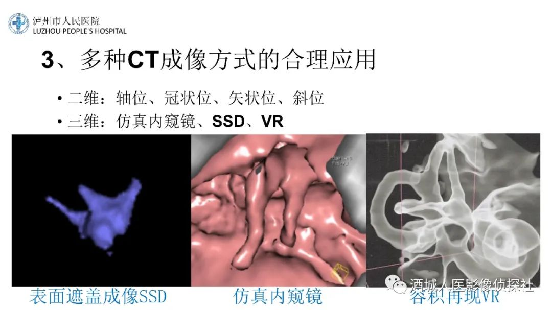 影像PPT - 【PPT】传导性耳聋的CT诊断-9