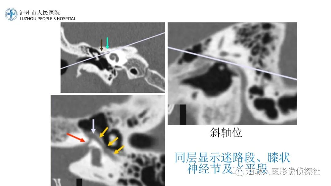 影像PPT - 【PPT】传导性耳聋的CT诊断-12