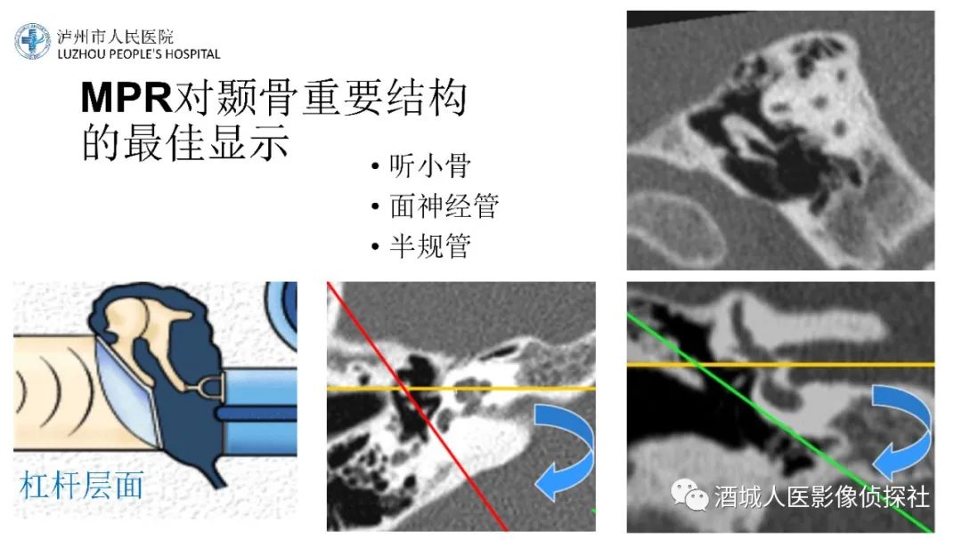 影像PPT - 【PPT】传导性耳聋的CT诊断-10