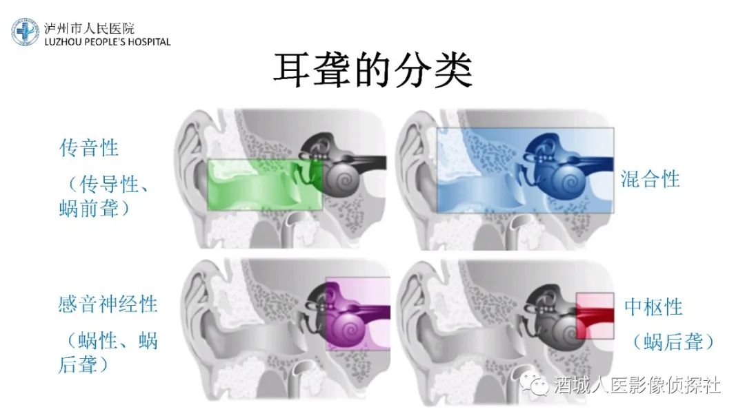 影像PPT - 【PPT】传导性耳聋的CT诊断-20