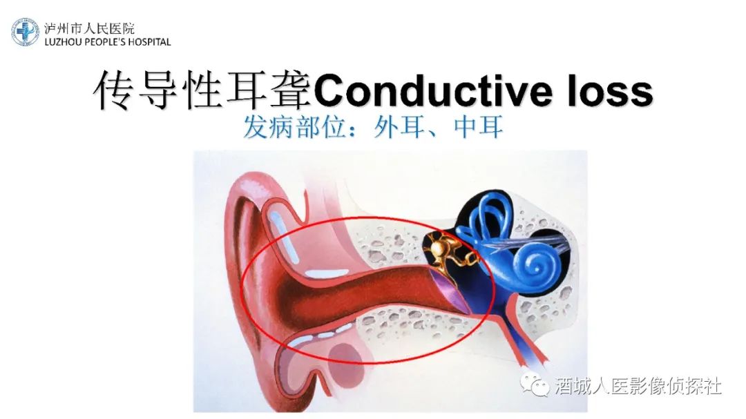 影像PPT - 【PPT】传导性耳聋的CT诊断-22