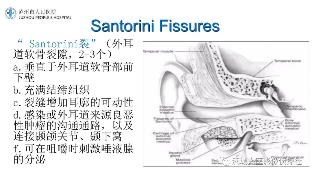 影像PPT - 【PPT】传导性耳聋的CT诊断-30