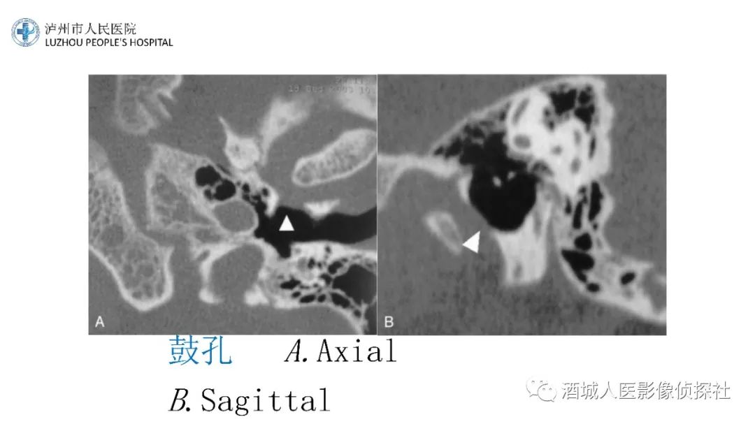 影像PPT - 【PPT】传导性耳聋的CT诊断-34