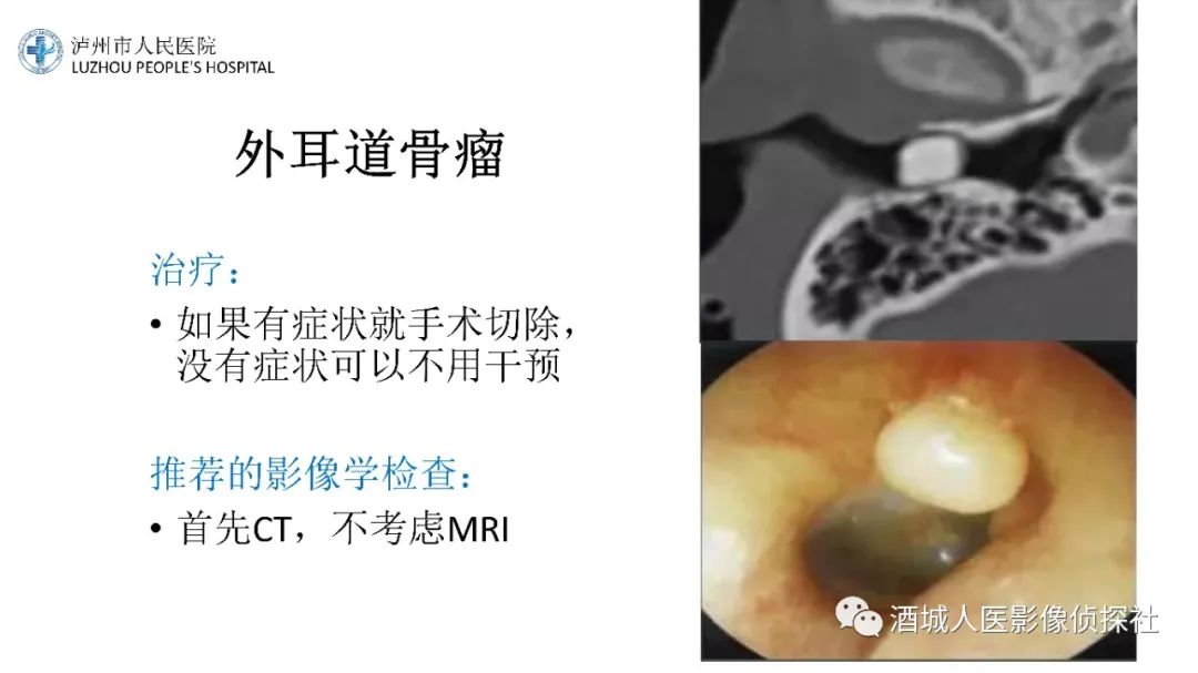 影像PPT - 【PPT】传导性耳聋的CT诊断-43