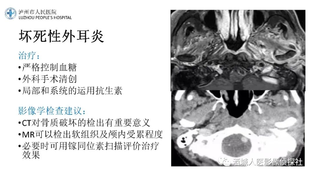 影像PPT - 【PPT】传导性耳聋的CT诊断-46