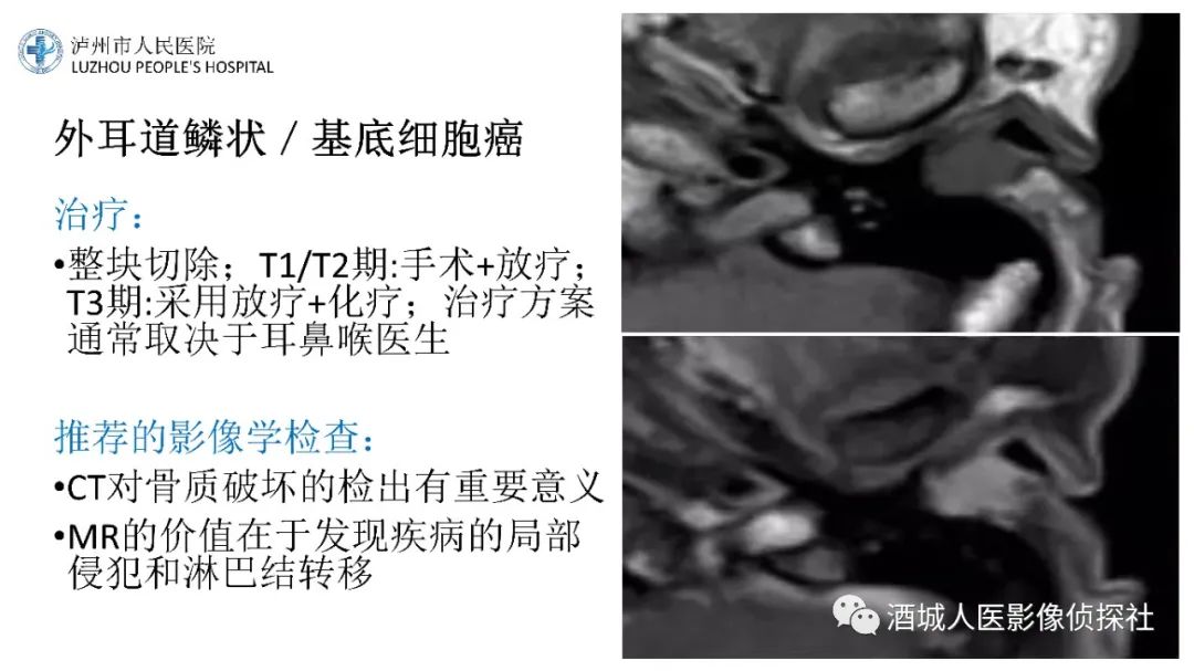影像PPT - 【PPT】传导性耳聋的CT诊断-49