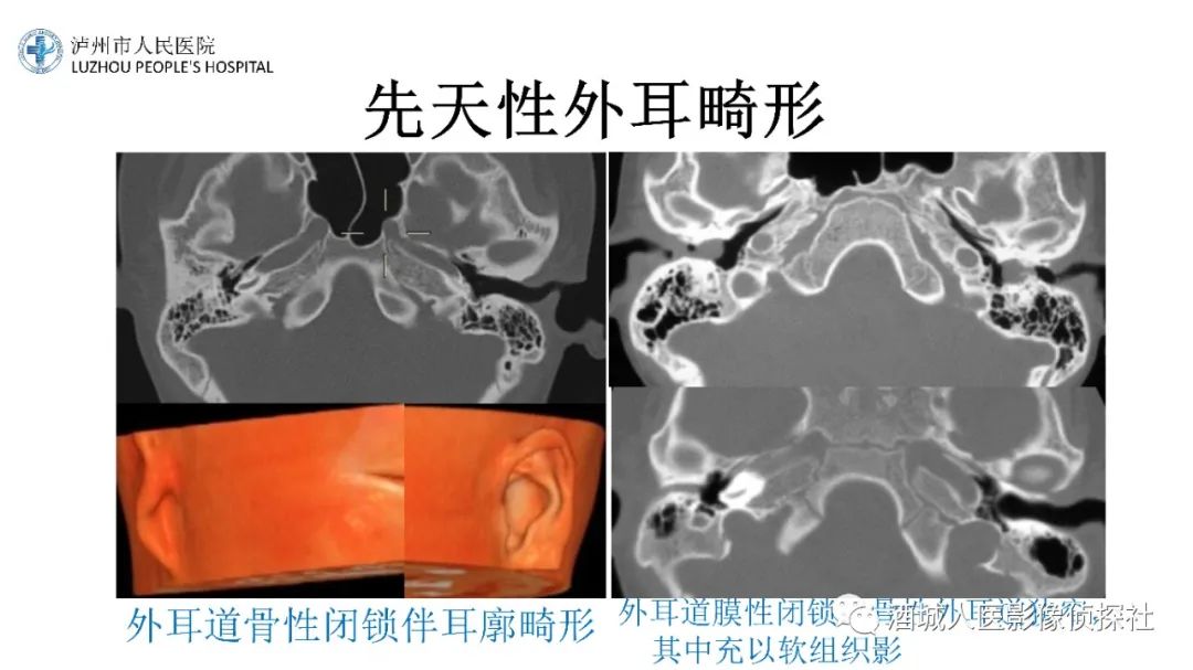 影像PPT - 【PPT】传导性耳聋的CT诊断-37