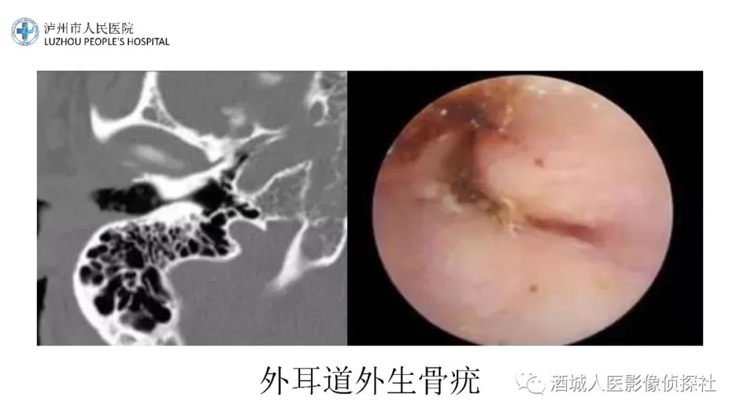 影像PPT - 【PPT】传导性耳聋的CT诊断-39
