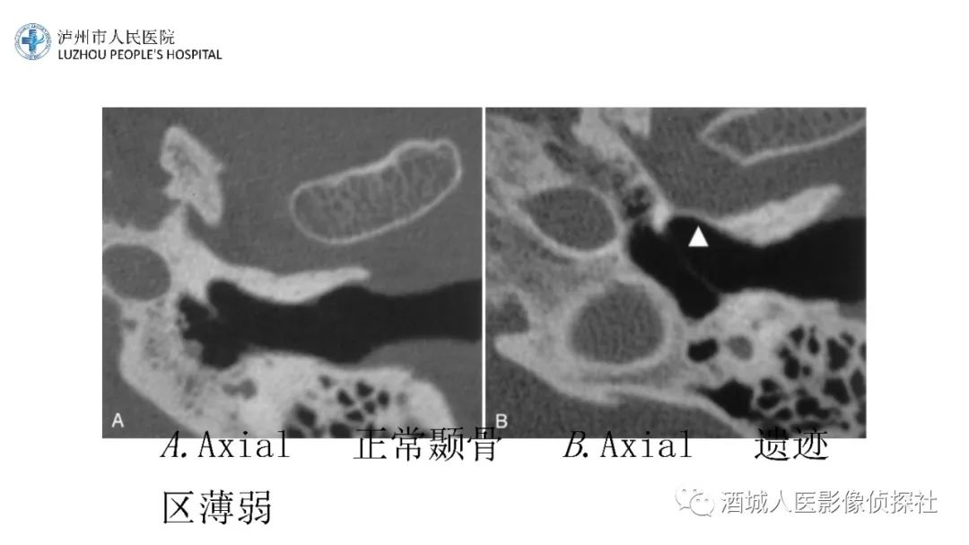 影像PPT - 【PPT】传导性耳聋的CT诊断-35