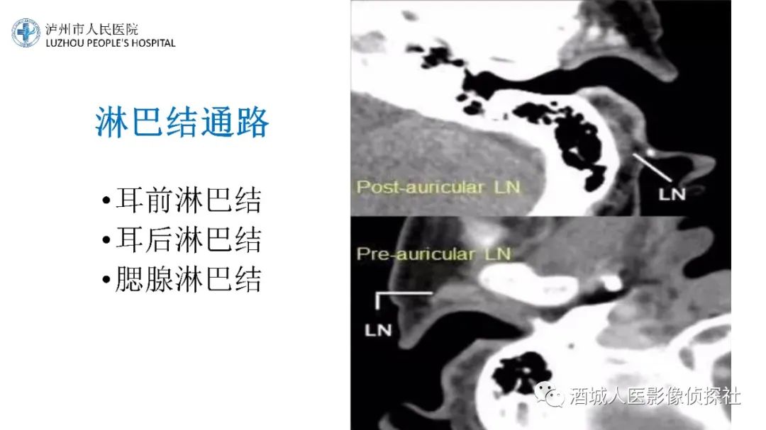 影像PPT - 【PPT】传导性耳聋的CT诊断-32